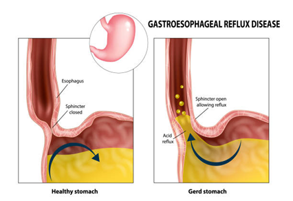 Comparison diagram: healthy stomach with the esophageal sphincter closed on the left and GERD stomach with the sphincter open causing acid reflux on the right.