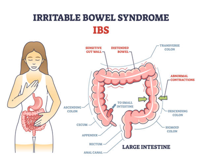 Educational diagram showing a woman with IBS and a labeled large intestine, highlighting a sensitive gut wall, distended bowel, abnormal contractions, and colon sections (ascending, transverse, descending).