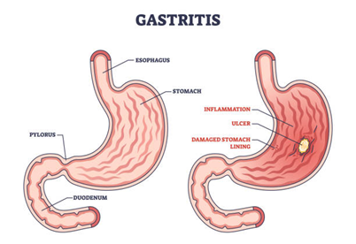 Medical illustration comparing a healthy stomach to one with gastritis: inflamed lining and an ulcer on the right side of the image