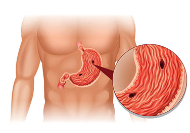 Medical illustration of a male torso showing the stomach with an ulcer; magnified view highlights a crater-like sore in the stomach lining.