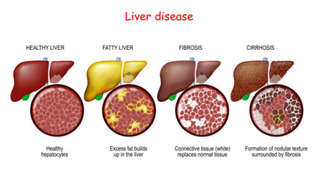 Diagram of liver disease progression: healthy liver to fatty liver to fibrosis to cirrhosis, with cross-sections showing tissue changes.