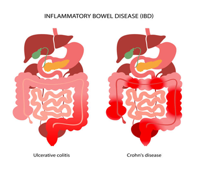 Comparison of ulcerative colitis and Crohn's disease: two digestive-tract diagrams with red inflamed areas; left shows continuous colon inflammation (ulcerative colitis), right shows patchy intestinal inflammation (Crohn's disease).