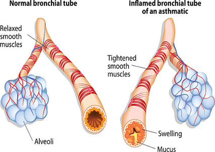 Side-by-side diagrams of a normal bronchial tube and an asthmatic, inflamed tube showing tightened muscles, swelling, and mucus.