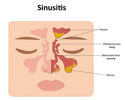 An anatomical diagram of a face illustrating sinusitis: inflamed sinus lining and mucus with labeled sinuses and obstructed openings.