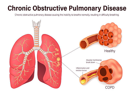 Diagram of healthy lungs vs COPD, showing normal alveoli compared with inflamed airways and mucus buildup in COPD.