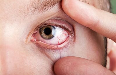 Close-up of a human eye with visible red veins, as fingers pull the eyelid open.