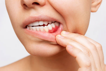 Close-up of a person biting their lower lip and exposing their front teeth.