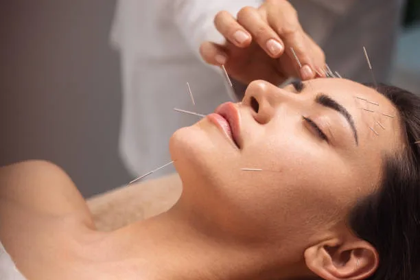 Woman lies on a treatment table with multiple fine acupuncture needles inserted around her forehead, temples, and cheeks for facial therapy.