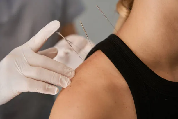 Gloved practitioner inserting acupuncture needles into a person's shoulder area.