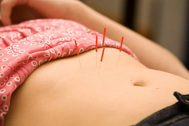 Abdomen with acupuncture needles inserted, partially covered by a pink patterned cloth, indicating a treatment session.