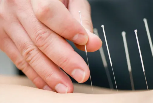 Acupuncture: a practitioner inserts thin needles into a person’s back.