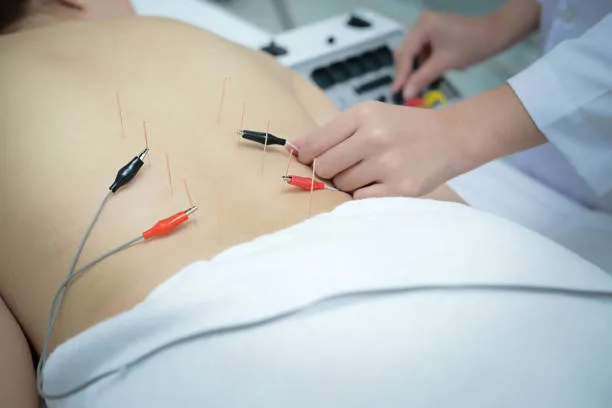 Person lying face down on a table with acupuncture needles in the back and electrical leads attached.