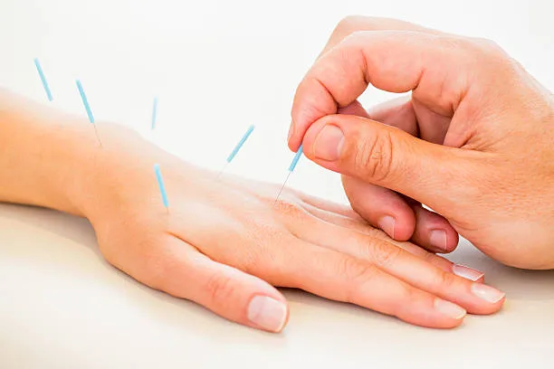 Acupuncture being performed on a hand with several thin blue needles inserted into the skin.