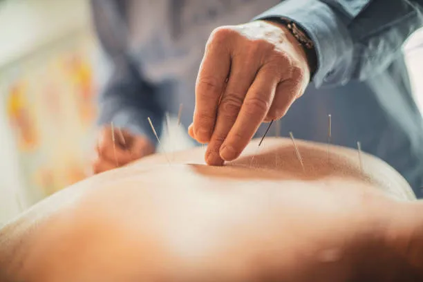 Acupuncture session: a practitioner inserts thin needles into a person's back during treatment.