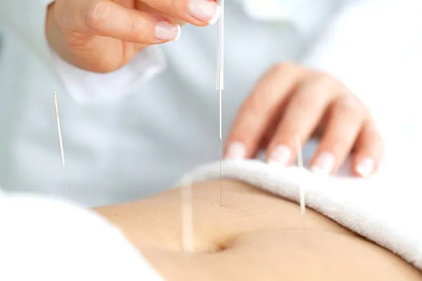 Acupuncture session: thin needles inserted into a patient’s abdomen while a practitioner handles another needle nearby.