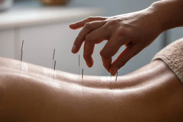 Close-up of thin acupuncture needles inserted into a person's back, with a practitioner's hand nearby.