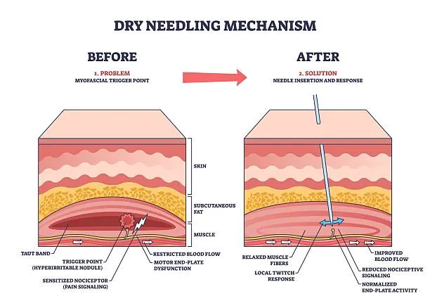 Diagram showing dry needling: before highlights trigger point in muscle with pain signaling; after shows needle insertion, relaxed muscle fibers, improved blood flow, and reduced nociceptive signaling.