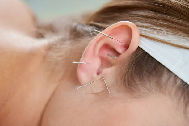 Close-up of an ear with several acupuncture needles inserted around the outer ear during a treatment.